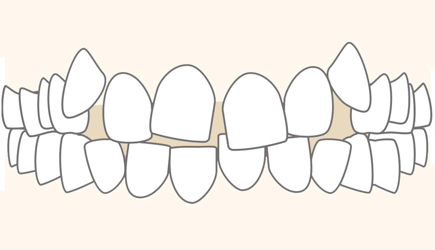 Crowded teeth photo