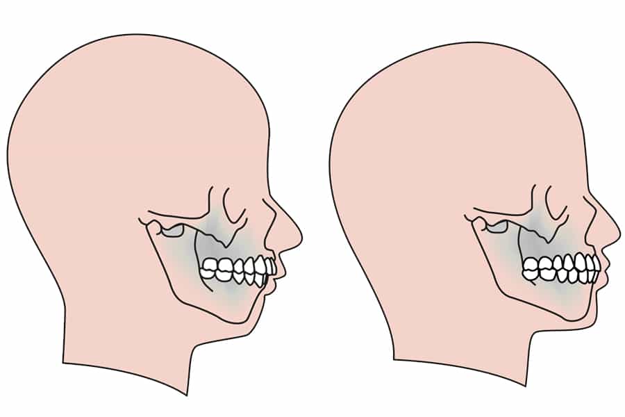 Chin comparison photo2
