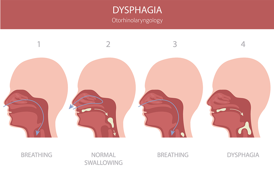 Dysphagia photo