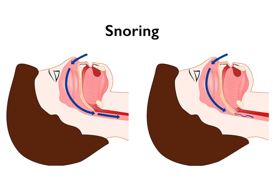 Snoring photo new